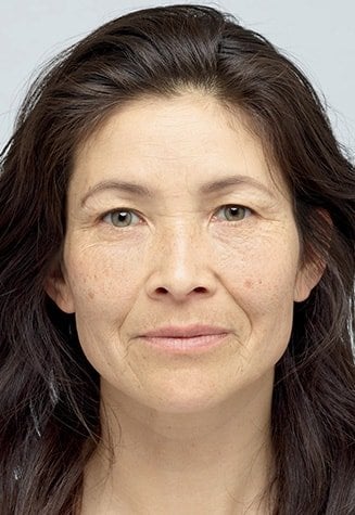 Hyaluronik Asit Kirisiklik Karsiti Serum (17)